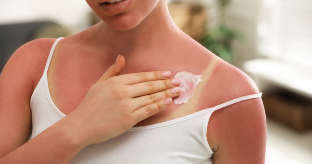 Cuando tu piel te traiciona: la historia de Clara y su verano sin bronceado